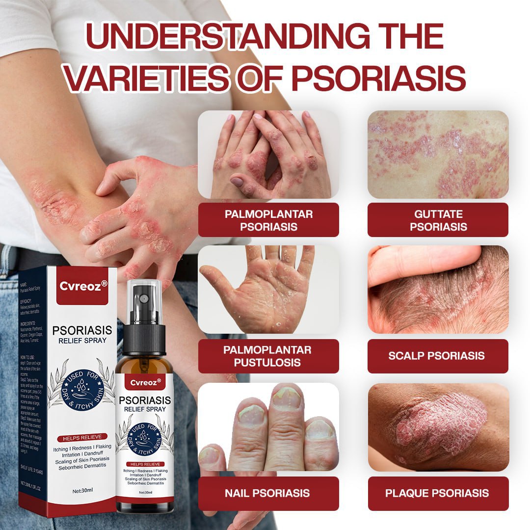 đ LIMITED OFFER: 60% OFF ONLY FOR TODAY đ CvreozÂź DermSoothe Psoriasis Relief Spray