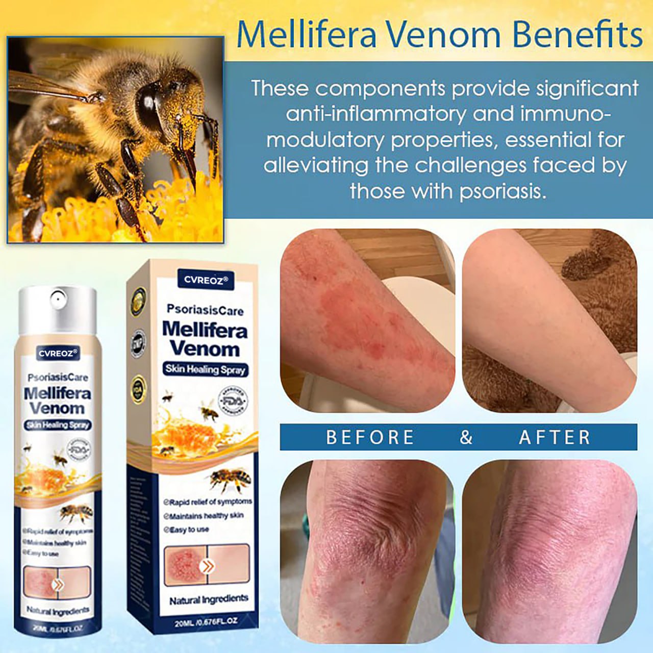 Cvreoz® PsoriasisCare Mellifera Venom Skin Healing Spray🔥