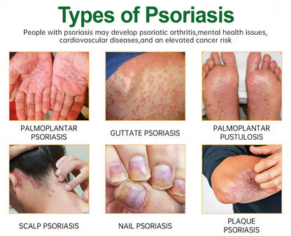 Cvreoz® Knotaway Psoriasis Cream🔥LIMITED SALE: 60% OFF🔥