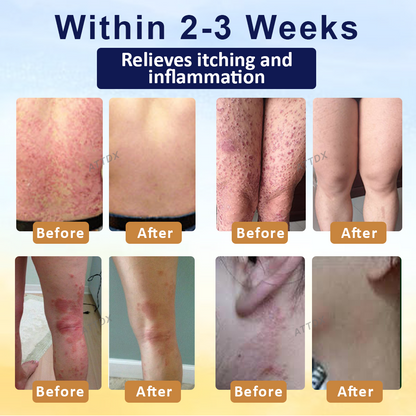 Cvreoz® PsoriasisCare Mellifera Venom Skin Healing Spray🔥
