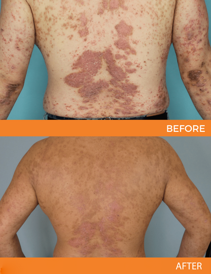 🐝 LIMITED OFFER 60% OFF 💛 Cvreoz® Psoriasis Bee Venom Care Spray