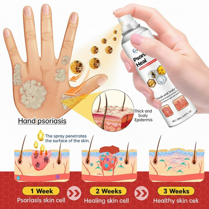 🎉HOT SALE: 60% OFF This Week Only!🔥 Cvreoz®  Psoriasis Heal Bee Venom Treatment Spray