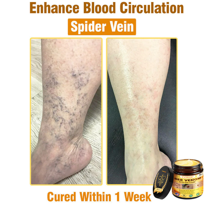 ⏰Last Day Promotion: 60% OFF🔥Cvreoz® Bee Venom All-in-One Cream