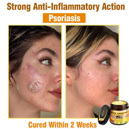 ⏰Last Day Promotion: 60% OFF🔥Cvreoz® Bee Venom All-in-One Cream