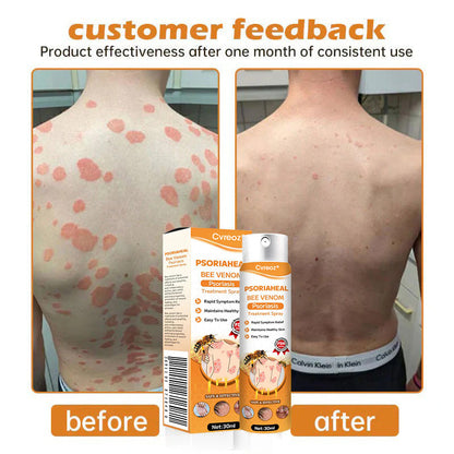 ⏰Last Day Promotion: 60% OFF🔥 Cvreoz® PsoriaHeal Bee Venom Psoriasis Treatment Spray