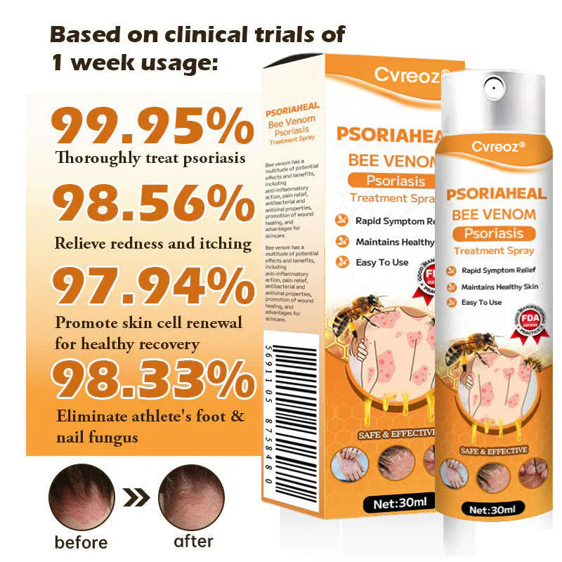 ⏰Last Day Promotion: 60% OFF🔥 Cvreoz® PsoriaHeal Bee Venom Psoriasis Treatment Spray