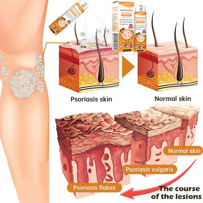 ⏰Last Day Promotion: 60% OFF🔥 Cvreoz® PsoriaHeal Bee Venom Psoriasis Treatment Spray