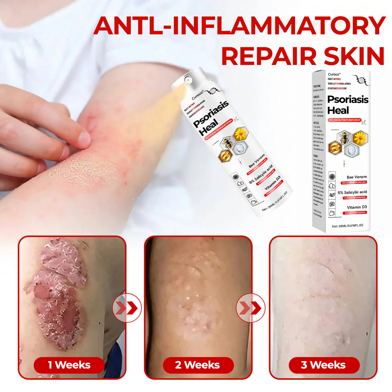 🎉HOT SALE: 60% OFF This Week Only!🔥 Cvreoz®  Psoriasis Heal Bee Venom Treatment Spray