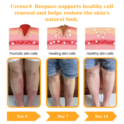 🔥 60% OFF – Cvreoz® Beepure psoriasis Skin Care