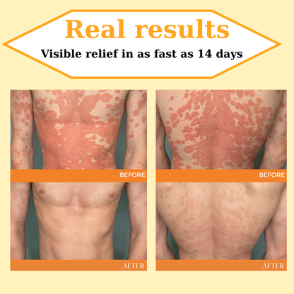 🔥 60% OFF – Cvreoz® Beepure psoriasis Skin Care