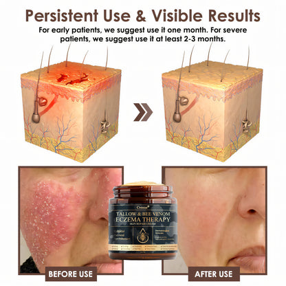 ⚡Final Chance: Save 60% Today Only🔥Cvreoz® Tallow & Bee Venom Eczema Theraphy