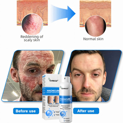 🎉SPECIAL LAUNCH OFFER: 60% OFF This Week Only!🔥 Cvreoz® MagniCure Psoriasis Treatment Spray