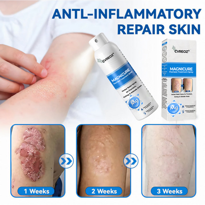 🎉SPECIAL LAUNCH OFFER: 60% OFF This Week Only!🔥 Cvreoz® MagniCure Psoriasis Treatment Spray