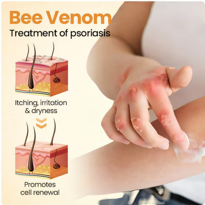 🔥 60% OFF – Cvreoz® Beepure psoriasis Skin Care