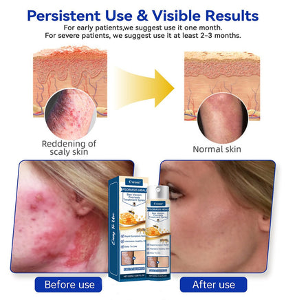 🐝 LIMITED OFFER 60% OFF 💛 Cvreoz® Psoriasis Heal Bee Venom Spray