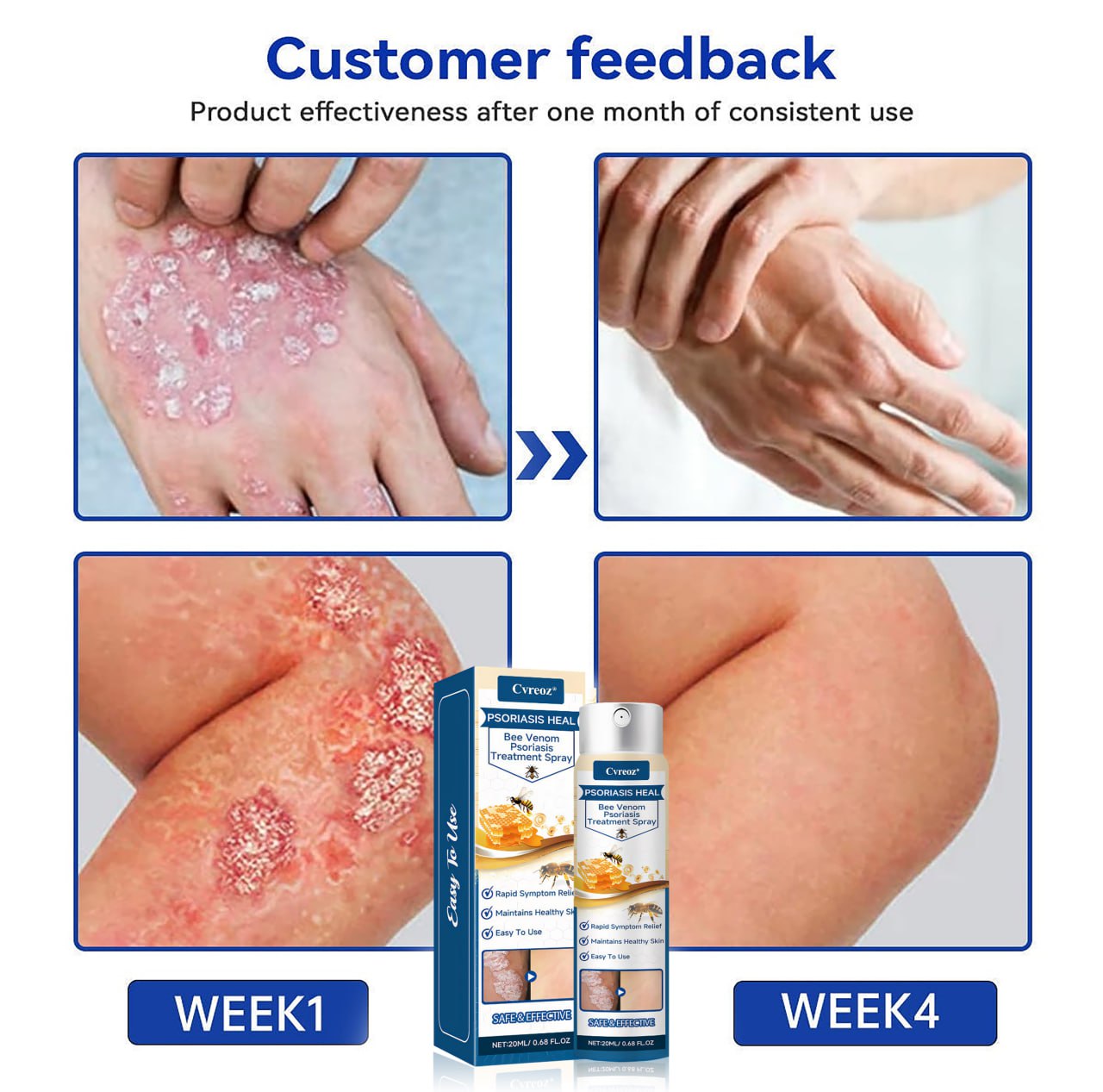 🐝 LIMITED OFFER 60% OFF 💛 Cvreoz® Psoriasis Heal Bee Venom Spray