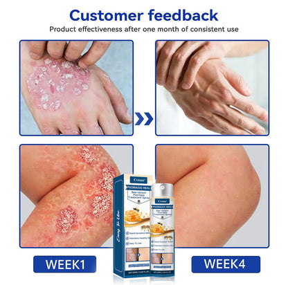 🐝 LIMITED OFFER 60% OFF 💛 Cvreoz® Psoriasis Heal Bee Venom Spray
