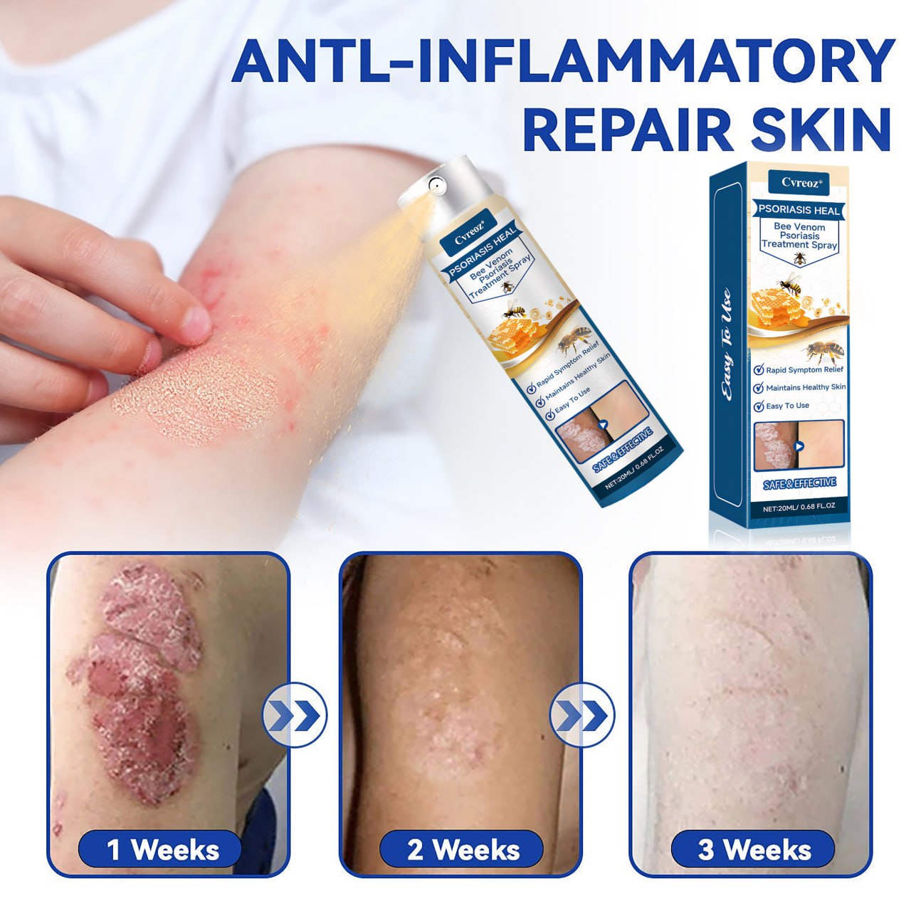 🐝 LIMITED OFFER 60% OFF 💛 Cvreoz® Psoriasis Heal Bee Venom Spray