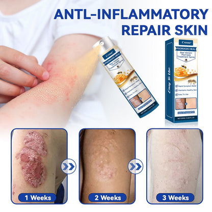 🐝 LIMITED OFFER 60% OFF 💛 Cvreoz® Psoriasis Heal Bee Venom Spray