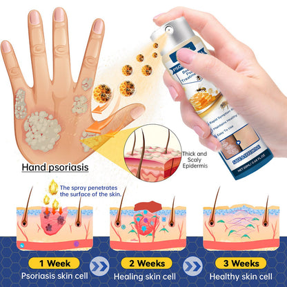 🐝 LIMITED OFFER 60% OFF 💛 Cvreoz® Psoriasis Heal Bee Venom Spray