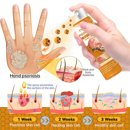 🐝 LIMITED OFFER 60% OFF 💛 Cvreoz® Psoriasis Bee Venom Care Spray