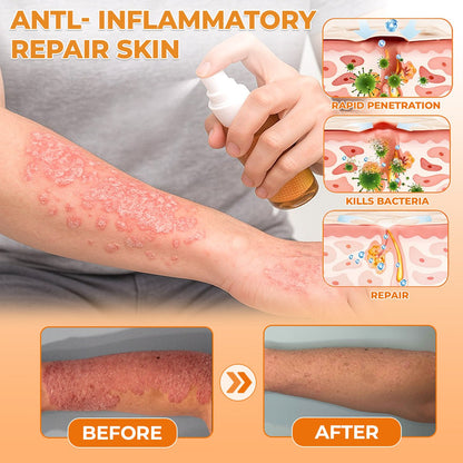 🐝 LIMITED OFFER 60% OFF 💛 Cvreoz® Bee Venom Psoriasis Relief Spray